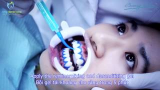 Tẩy trắng răng  Teeth Whitening with Beaming White USA [upl. by Xela675]