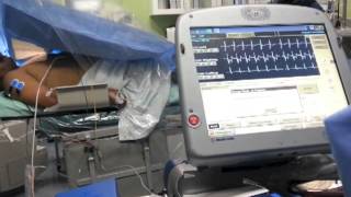 AICD defibrillation threshold test [upl. by Henleigh]