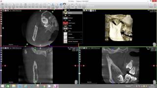 XMind Trium 3rd molar virtual endoscope [upl. by Morvin]