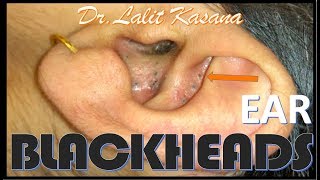 EAR COMEDONES by DrLalit Kasana [upl. by Hernandez]