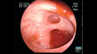 Diverticular Bleeding [upl. by Eecrad647]