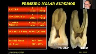 ANATOMIA INTERNA e CIRURGIA DE ACESSO ENDODÔNTICO EM MOLARES parte 1 [upl. by Coulson]