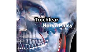 Trochlear Nerve Palsy  English [upl. by Eiralam44]