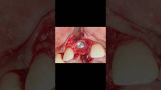 Immediate Implant placement  Luxator extraction Osseodensification  Bone Grafting PERIO SUBHARTI [upl. by Anastos403]