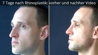 7 Tage nach Rhinoplastik vorher und nachher Video [upl. by Soisanahta]