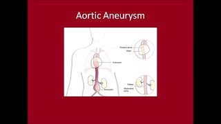 Management of Aortic Aneurysms [upl. by Aydiv]