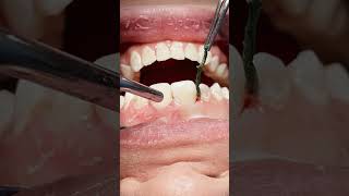 Class V tooth caries composite restoration dentisry [upl. by Corwin]