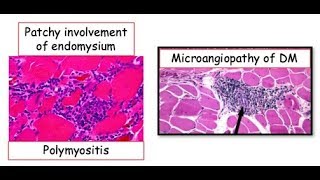 12DaysinMarch Podcast Series Myositis for the USMLE Step One Exam [upl. by Ecidnak]