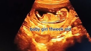 Baby girl 11weeks old ultrasound baby babygirl healthybaby subscribe my channel for more video [upl. by Hoagland116]