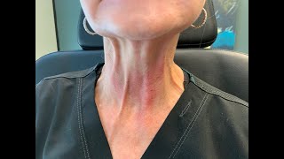 Injecting Botox in the Neck to relax neck bands [upl. by Alf228]