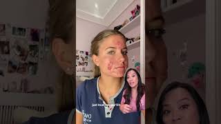 💕 this Severe acne vulgaris and SUCCESS with Accutane aka isotretinoin [upl. by Phillida]