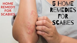 What to do if you have scabies [upl. by Marybelle150]