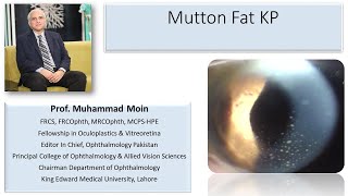 Mutton Fat Keratic Precipitates [upl. by Rexford]