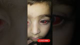 Bilateral Subconjunctival Hemorrhage hospital shorts bilateralviral video tranding [upl. by Nylear830]