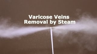 Varicose Vein Removal by Steam Vein Sclerosis from CermaVein [upl. by Ted]