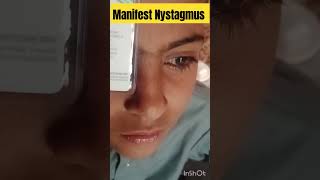 manifest Nystagmus  nystagmus eyediseases [upl. by Okimuy]