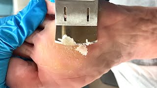 Callus removal from feetampFoot scraping dead skin【Xiao Yan pedicure】stress 39 [upl. by Jenni]