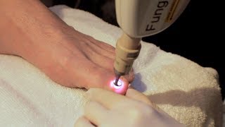 Laser Treatment of Toe Nail Fungus [upl. by Avat]