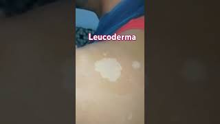 Leucoderma visit Anm herbal health and skincare clinic Lucknow 📞 9235735335 [upl. by Enenej]