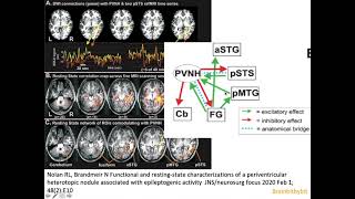 7 Heterotopia epilepsy PVNH malformation cortical development filamin CDK5 MRI neuroradiology [upl. by Rehpotsrihc]