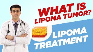 Whats a LIPOMA TUMOR  How Lipoma can be Treated  Dr Anirudh Vij [upl. by Zelle529]