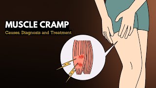 Muscle cramp Causes Signs and Symptoms Diagnosis and Treatment [upl. by Enak]