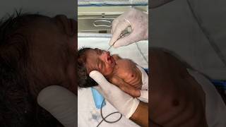 Newborn Anomalies TEFcleftlip cleftpalate syndrome trendingshortsvideo [upl. by Fionnula]