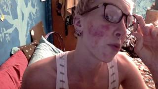 Treating Rosacea AGAIN [upl. by Eeresed]