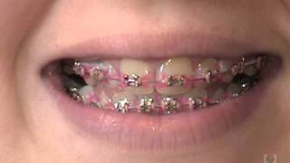 Orthodontic Care Videos  Disclosing Tablets [upl. by Talley]