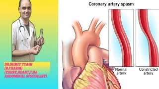 ABOUT THE SYMPTOMS OF CHRONIC ANGINA PACTOTARIS BY DRSUMIT TYAGISUMITMEDICALDISPENSARY1 [upl. by Assirok718]