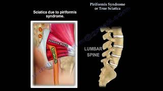 Piriformis syndrome or disc herniation how do you tell the difference  a confusing presentation [upl. by Noe]