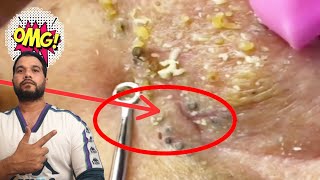 blackhead extraction  nose blackheads removal  nose blackhead [upl. by Pease]