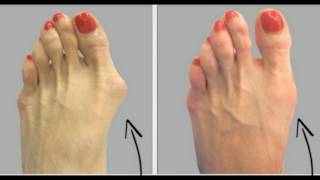 WHY DO DOCTORS KEEP THIS SIMPLE RECIPE AWAY FROM THE PUBLIC HERE’S HOW TO GET RID OF BUNIONS NATURAL [upl. by Stoops]