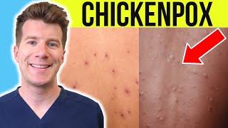 Doctor explains CHICKENPOX  Causes Stages Symptoms Treatment PLUS PHOTOS [upl. by Aem]