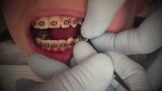 Herbst Appliance for correction of class II correction with braces 2013 [upl. by Tesil]