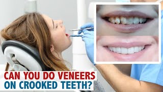 Can you do veneers on crooked teeth [upl. by Ulphi]