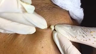 How To Remove Blackheads And Whiteheads On Face Easy 17 ✦ Dr Laelia ✦ [upl. by Deva]