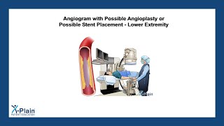 Angiogram with Possible Angioplasty or Possible Stent Placement  Lower Extremity [upl. by Atihcnoc351]
