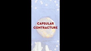 Dr Pancholi Frees a Textured Breast Implant from Hardened Capsule After Capsular Contracture Case [upl. by Ardnuahc462]