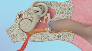 Clogged Ear Due to Ear Infection or Eustachian Tube Dysfunction [upl. by Nytram84]