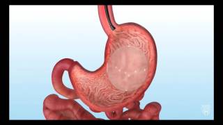 Endoscopic Gastric Balloon for Bariatric Weight Loss [upl. by Sewel]