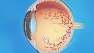 Epiretinal Membrane Surgery [upl. by Yeldnarb]