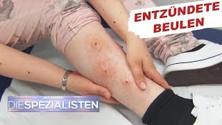 Beulen an den Beinen Parasitenbefall  Auf Streife  Die Spezialisten  SAT1 TV [upl. by Hildick]