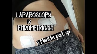 MY ENDOMETRIOSIS STORY  BEFORE amp AFTER LAPAROSCOPY DIAGNOSIS [upl. by Mita]