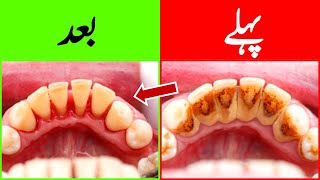 How to Remove Dental PlaqueTartar Home Remedy  دانتوں کی صفائی کا گھریلو علاج  Dr Cas [upl. by Anyg]