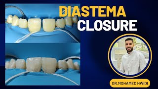 Diastema closure with composite [upl. by Clapp]