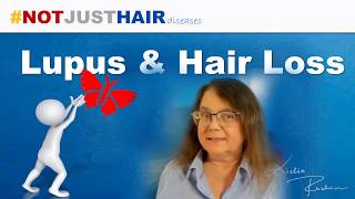 Lupus amp Hair Loss Symptoms Prevention and Treatment [upl. by Ahsikyt]