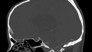 Basilar platybasia and invagination or impression in a case with chronic hydrocephalus [upl. by Ericha667]