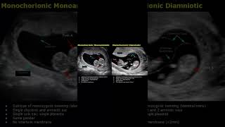 Monochorionic Monoamniotic amp Monochorionic Diamniotic Twins Ultrasound Scan  Pregnancy USG shorts [upl. by Adnala]