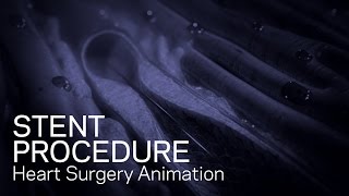 Stent Procedure  Medical Animation [upl. by Aihsenad488]